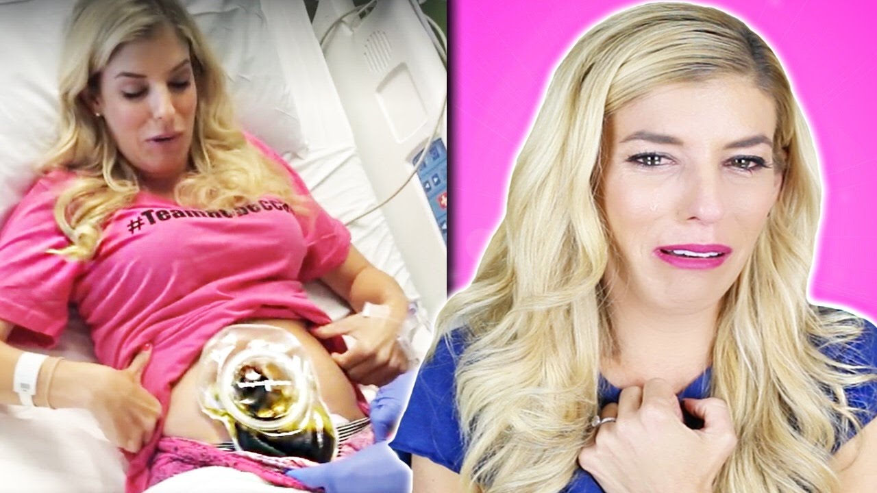 I HAD MY COLON REMOVED! | STORYTIME